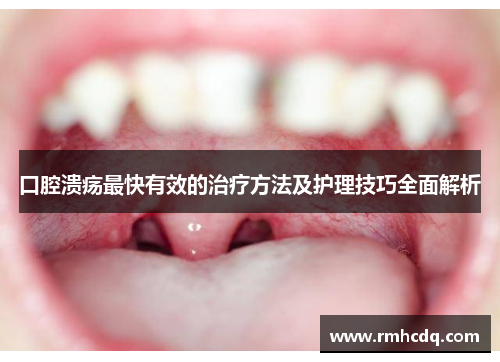 口腔溃疡最快有效的治疗方法及护理技巧全面解析